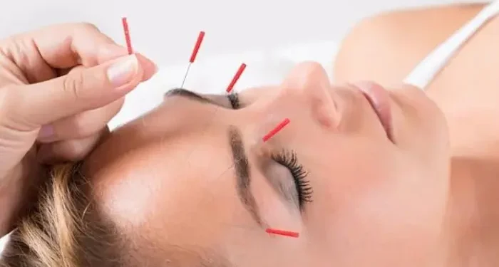 Acupuncture Consent Form